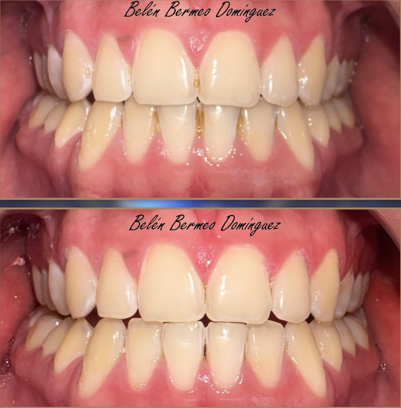 Antes y después de profilaxis dental