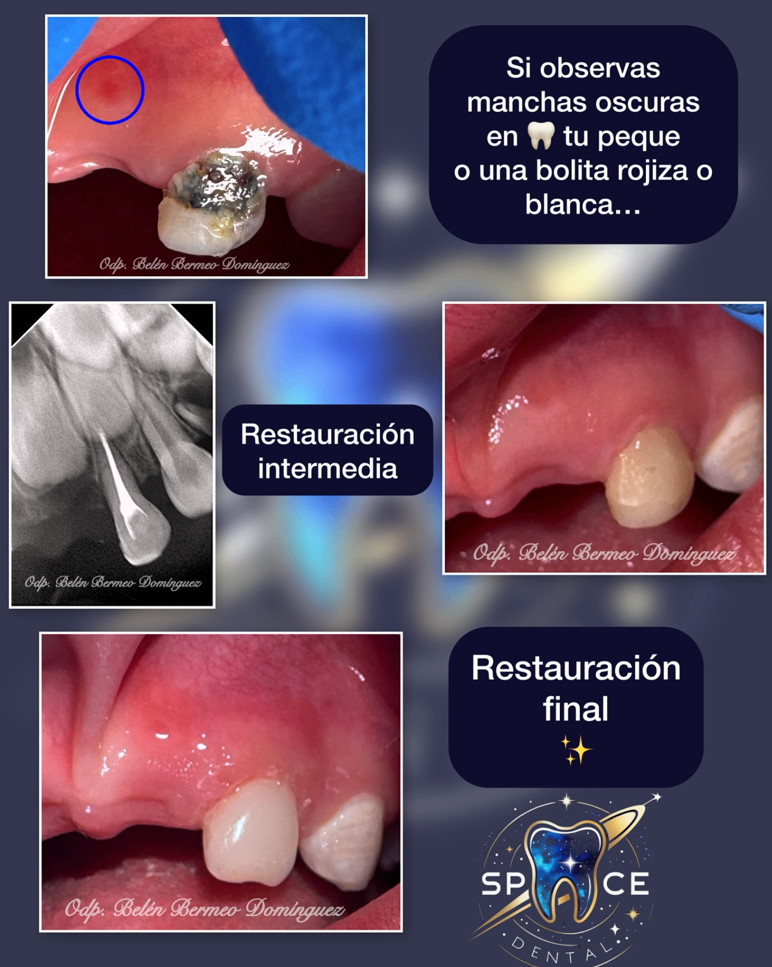 Restauración paso a paso en paciente infantil