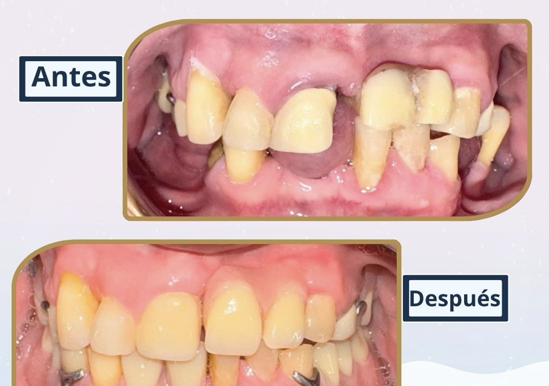 Antes y después de rehabilitación dental